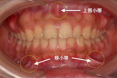 小帯切開術 